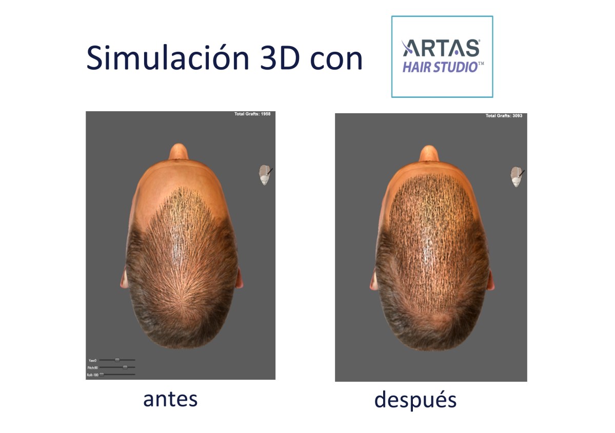Robot Artas Lopez Bran trasplante de pelo