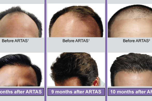 pelo antes y después robot artas