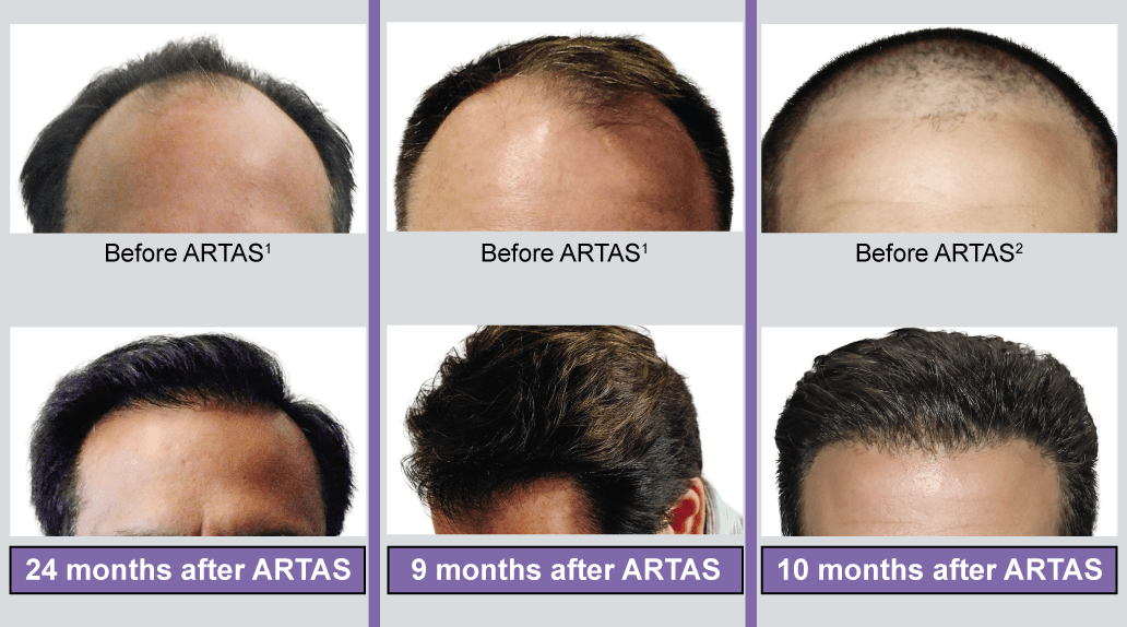 pelo antes y después robot artas