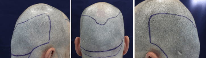 Ejemplo de buena zona dadora - Blog Eduardo López Bran