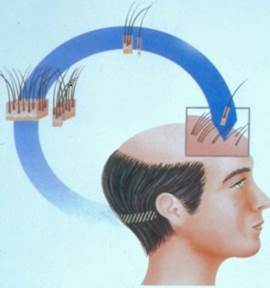 Cómo se hace un trasplante de pelo - Eduardo López Bran