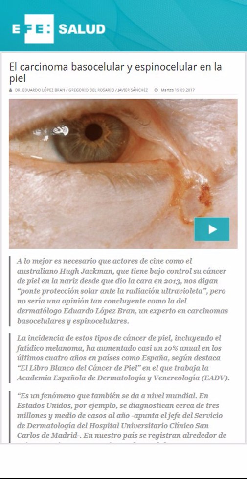 Tratamiento Carcinoma Dermatología Cáncer de piel. Dr. López Bran